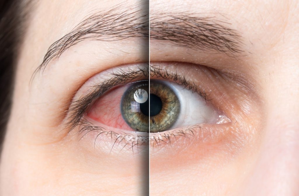 Close up split screen view of women with dry eye on the left and eye with no symptoms on the right