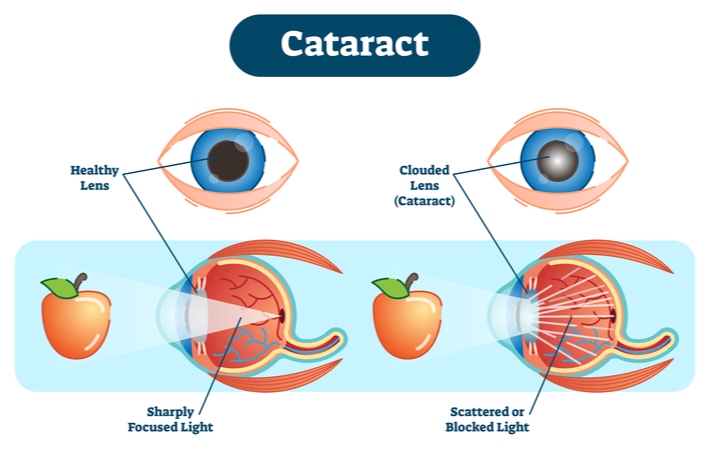 Graphic of two eye cross sections, with healthy lens on the left and the cloudy lens (cataract) on the right. The left eye shows sharply focused light passing through the lens, while the right eye shows scattered/blocked light due to cataract.