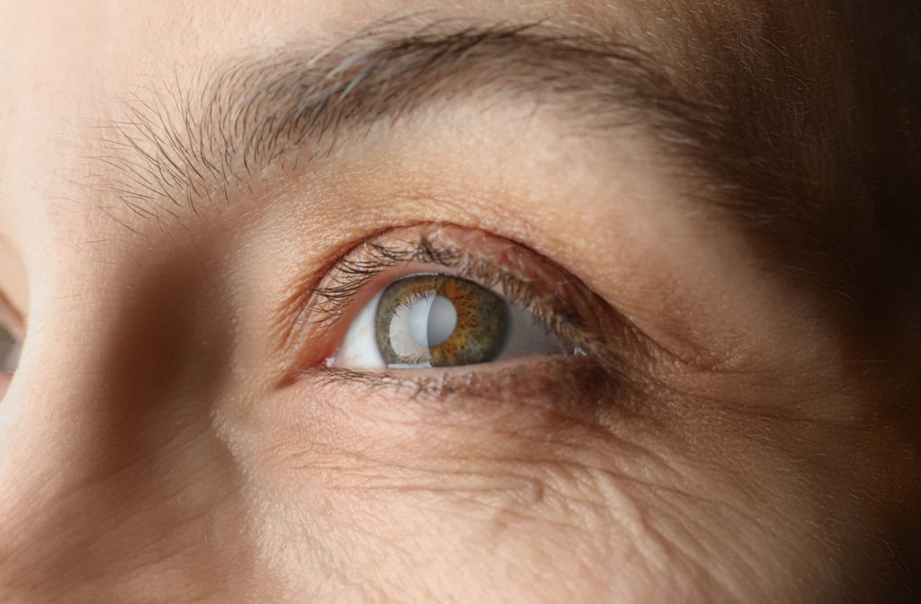 Close up image of a mature patient's eye showing the cloudiness associated with a cataract.