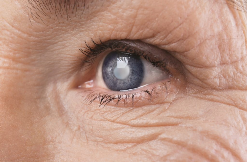 Close up image of a senior woman's eye showing a cataract.