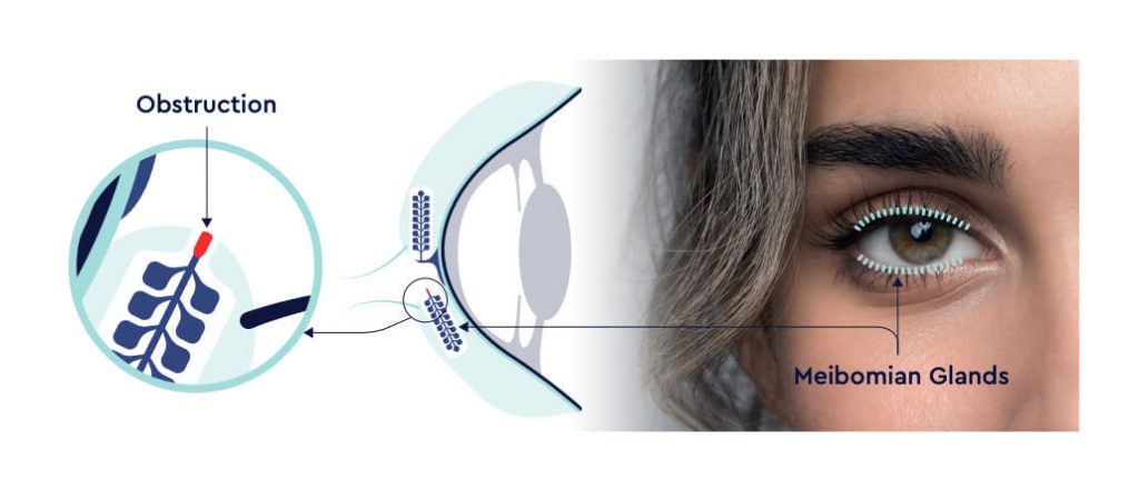 Graphical representation showing a blocked meibomian gland and showing its location along the eye lids.