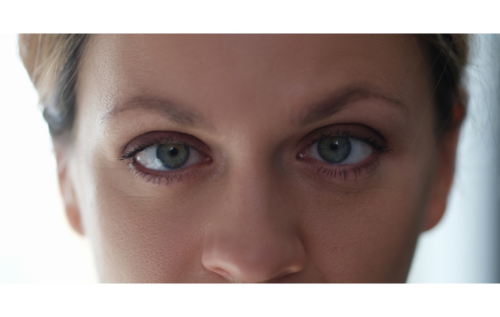 Adult woman displays symptoms of amblyopia in one eye.