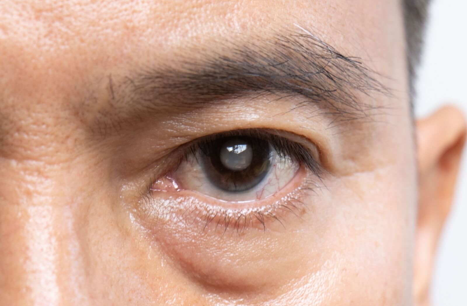 Close-up of a person's eye with cloudy cataracts visible in the lens.