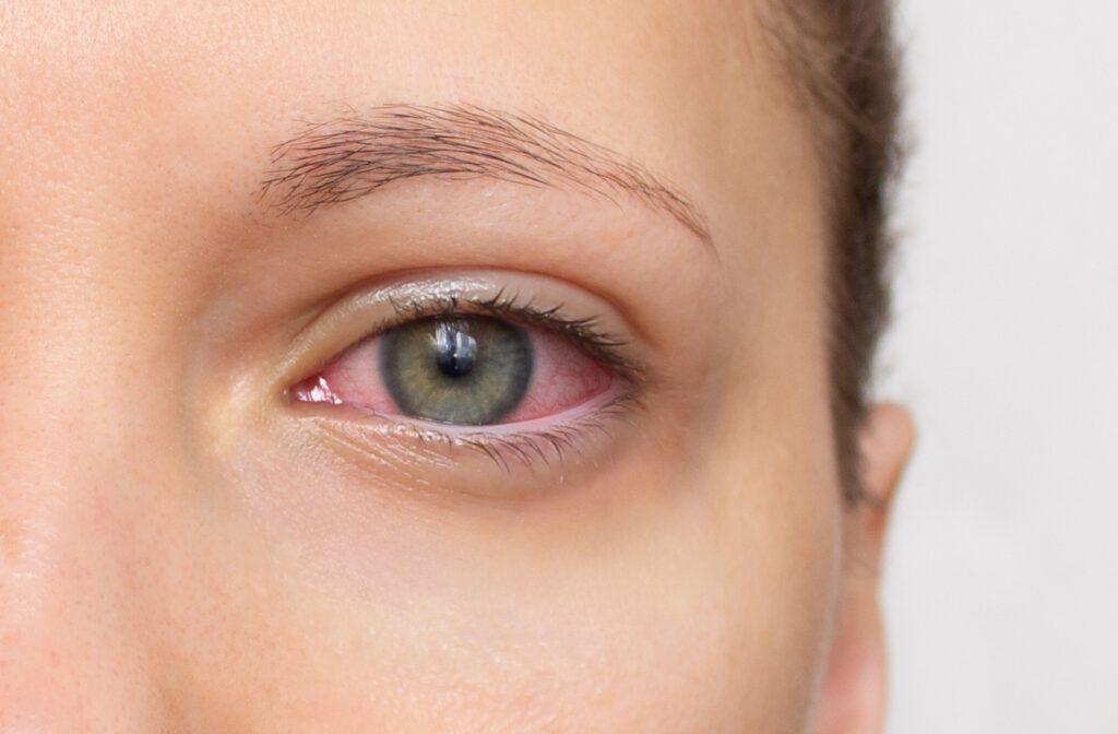 A close-up of a person's red, irritated eye.