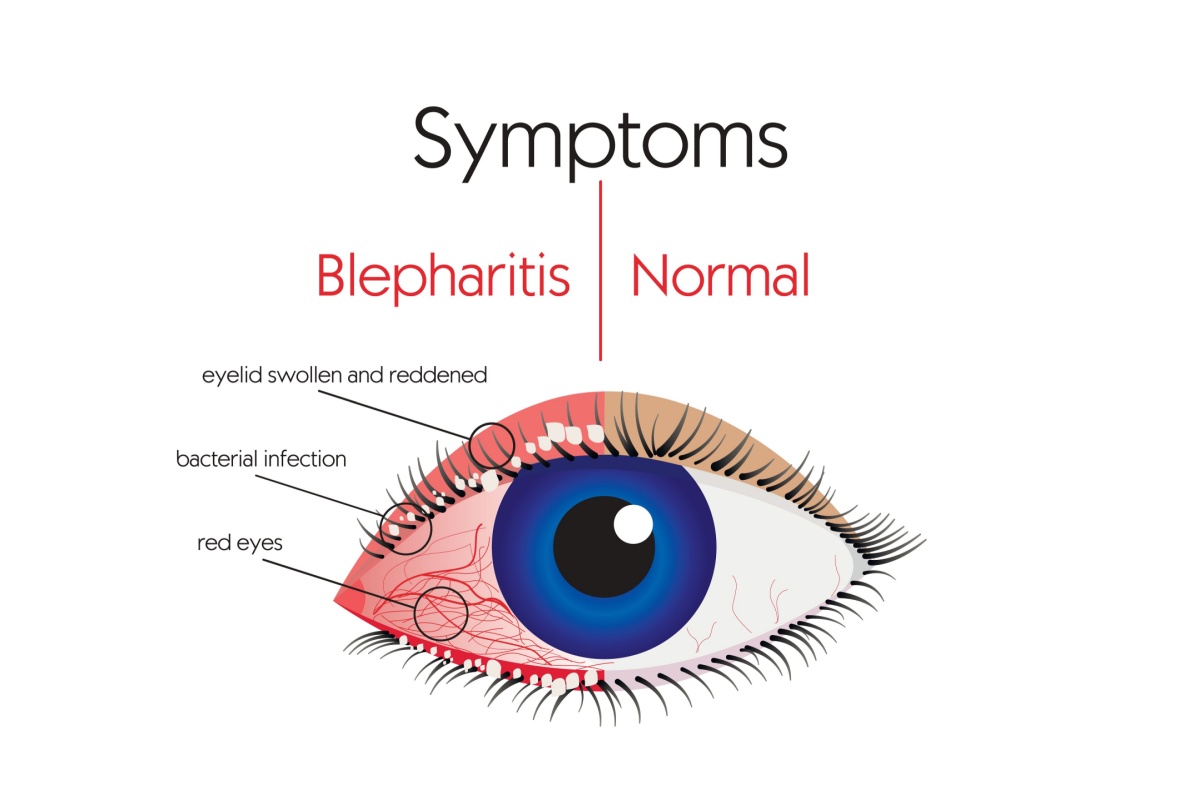 Illustration comparing a healthy eye to one affected by blepharitis, showing red and swollen eyelids, bacterial infection along the lash line, and eye redness.