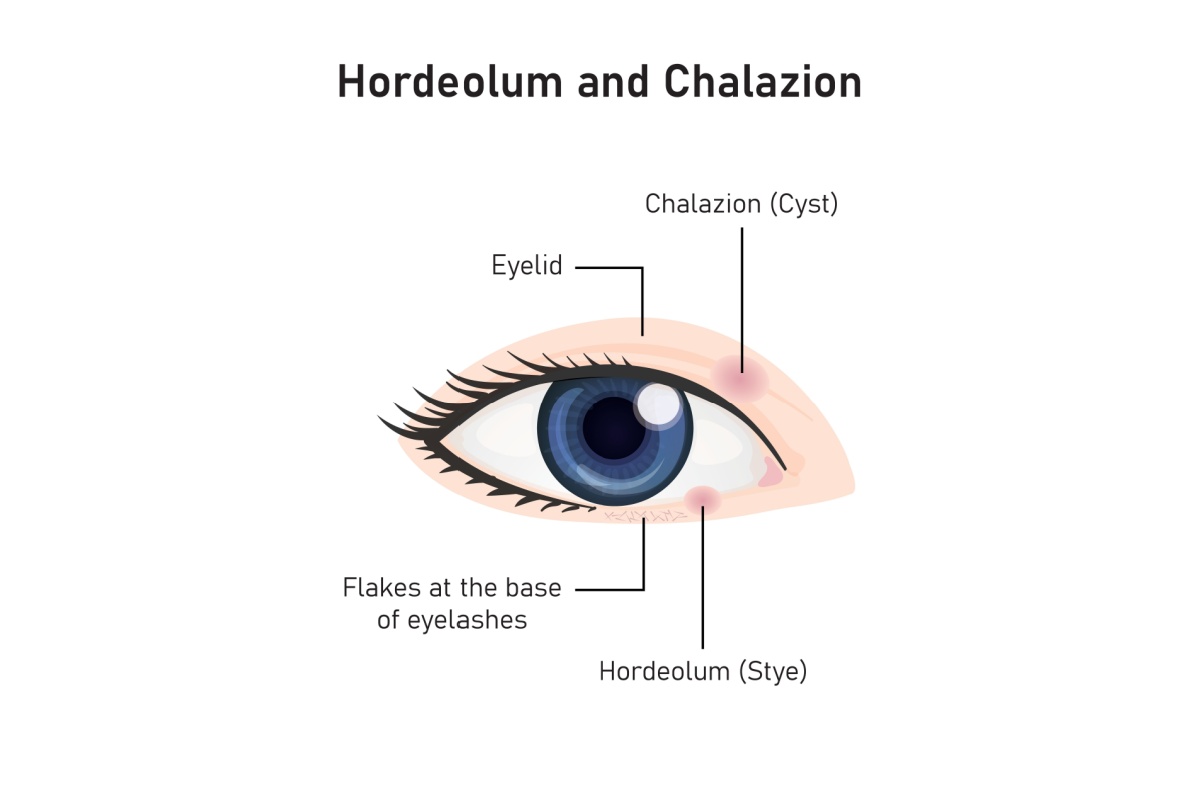 Diagram showing the difference between a hordeolum (stye) and a chalazion (cyst), highlighting eyelid anatomy, flakes at the base of eyelashes, and localized swelling.