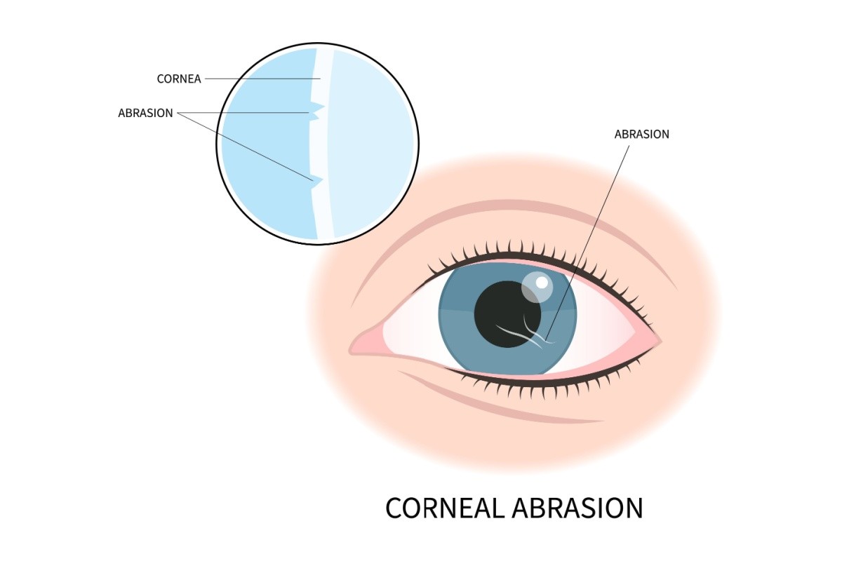 An educational medical diagram titled 'CORNEAL ABRASION' showing a blue human eye with a visible scratch on the surface. An inset circular illustration provides a zoomed-in cross-section of the cornea, highlighting small nicks or abrasions on its outermost layer.